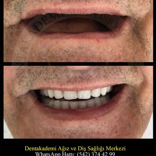 ALL ON 6 Before / After photo
